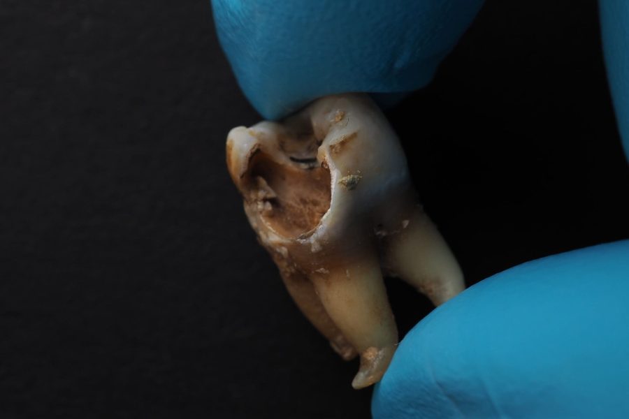 Gömük Diş Tedavisi MedipiaDent